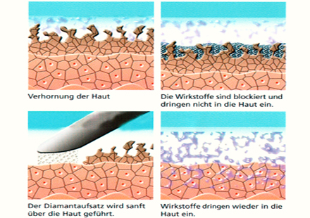 Figur in Form - Gesund -Schlank -Fit - Mikrodermabrasion - Wirkungsweise